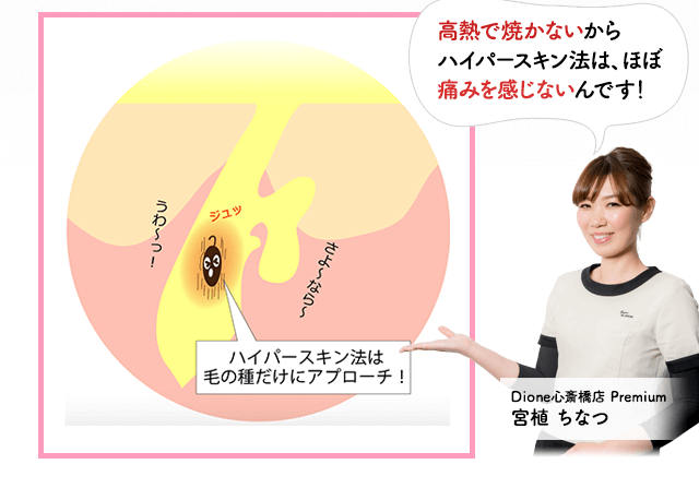 ハイパースキン法は毛の種だけにアプローチ。高熱で焼かないからハイパースキン法はほぼ痛みを感じないんです。ディオーネ心斎橋店宮植ちなつ