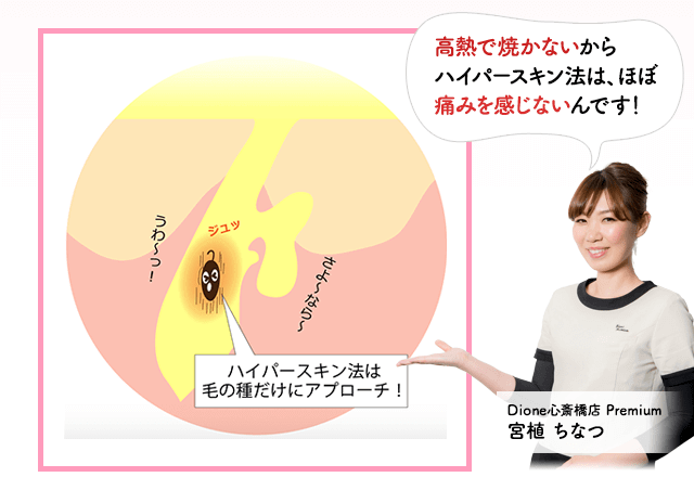 ハイパースキン法は毛の種だけにアプローチ。高熱で焼かないからハイパースキン法はほぼ痛みを感じないんです。ディオーネ心斎橋店宮植ちなつ